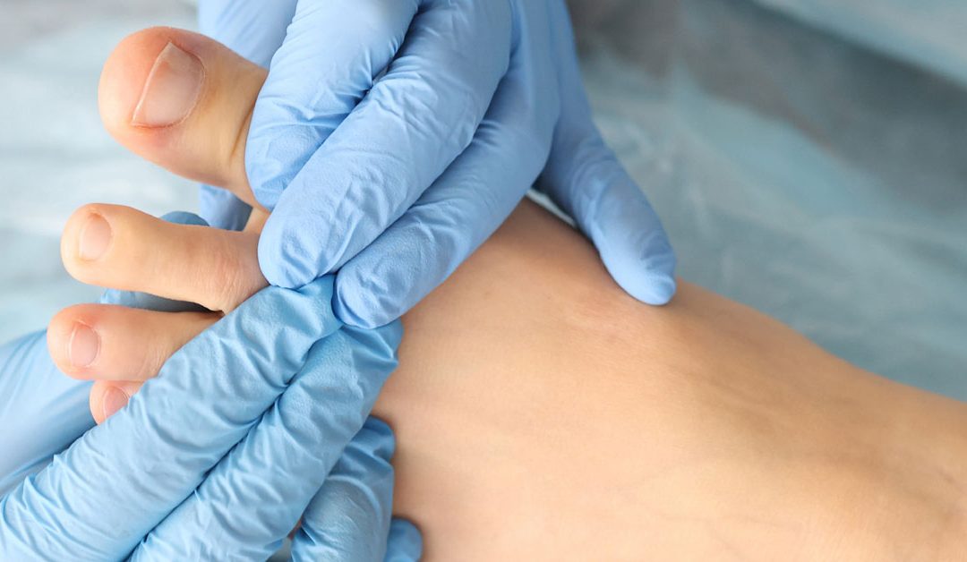 4 mitos de los hongos en los pies